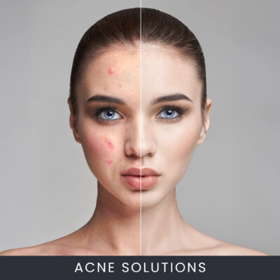 Acne Solutions Facial Course Acne Solutions Facial Course