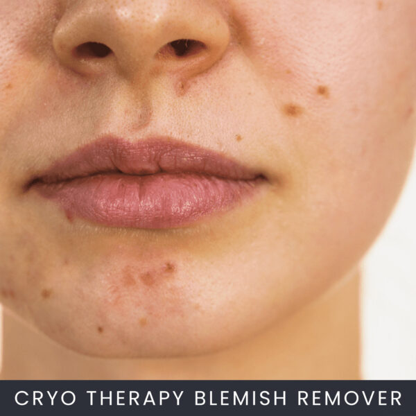 Online Cryo Therapy Blemish Remover Course Online Cryo Therapy Blemish Remover Course