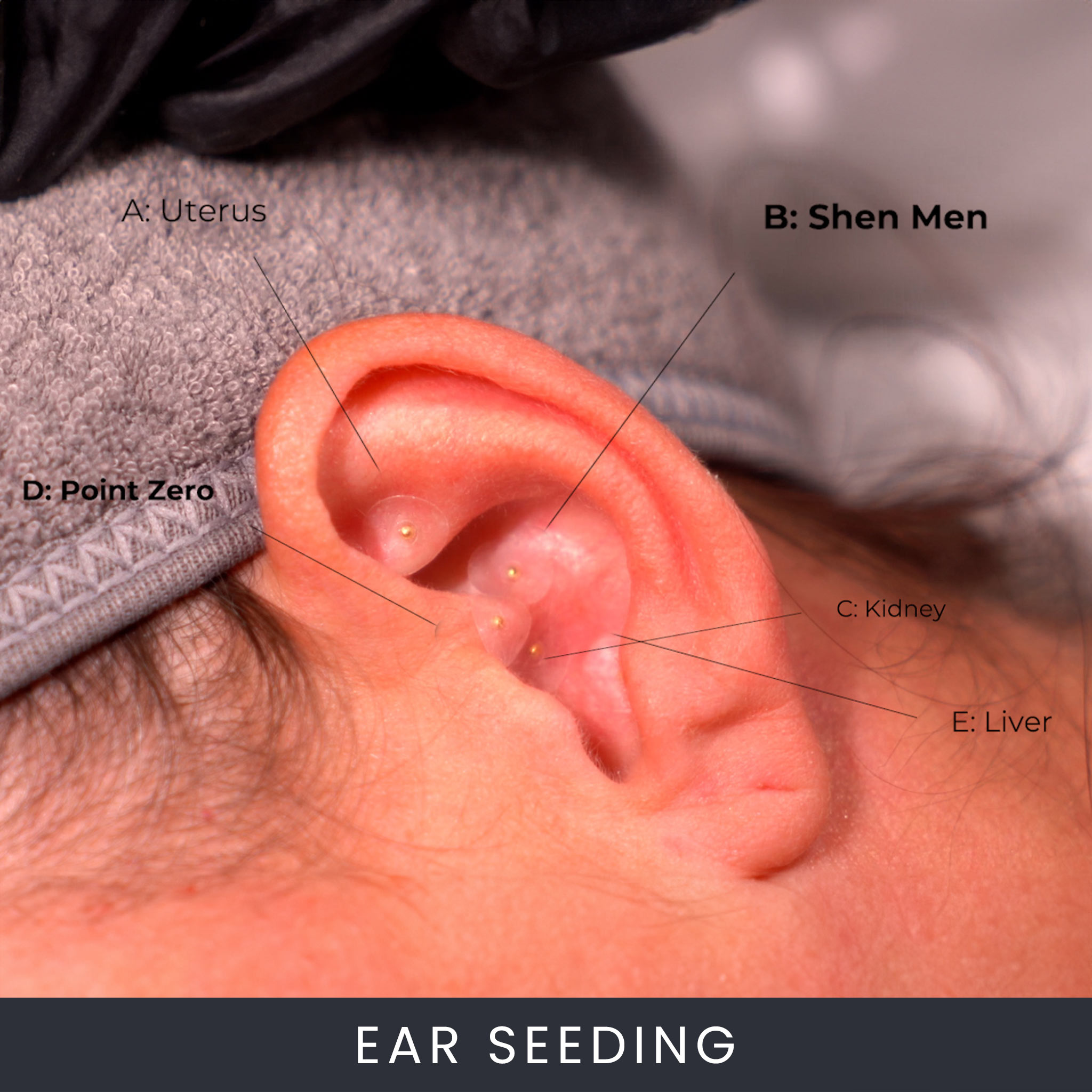 Online Ear Seeding Auricular Therapy Course