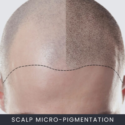 Online Scalp Micro-Pigmentation Course