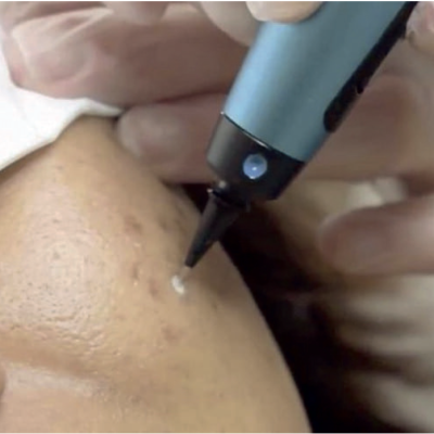 Cryo Therapy Blemish Removal