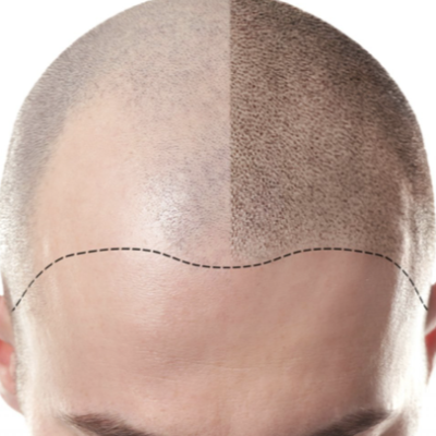 Scalp Micro-Pigmentation