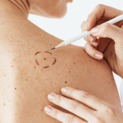 Skin Tag Removal Course
