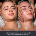 before and after of korean facial contour massage